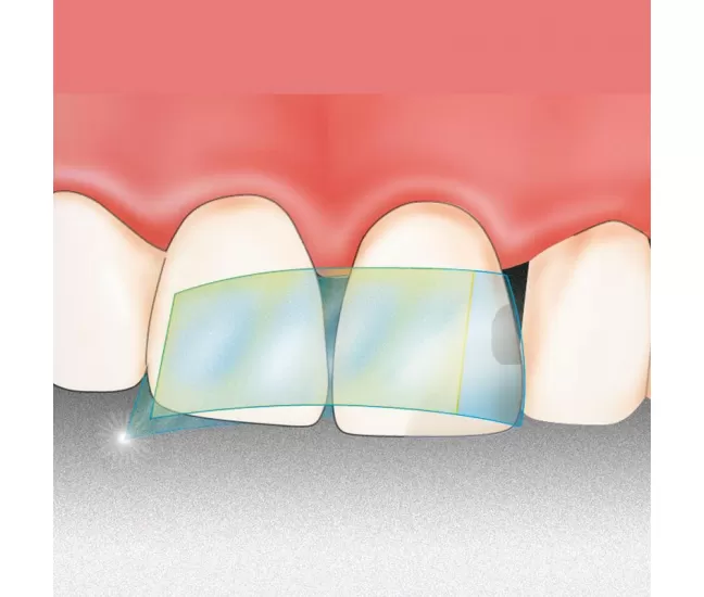 Самоклеящаяся пластиковая матрица Dispens-O-Mat Anterior 7 мм, 100 шт.