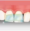 Самоклеящаяся пластиковая матрица Dispens-O-Mat Anterior 7 мм, 100 шт.