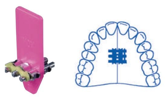 Orthodontic expansion screw standard A0805-95