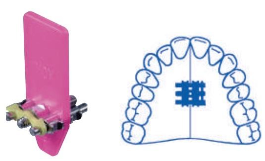 Orthodontic expansion screw standard A0805-96