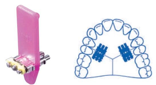 Orthodontic expansion screw medium A0803-95