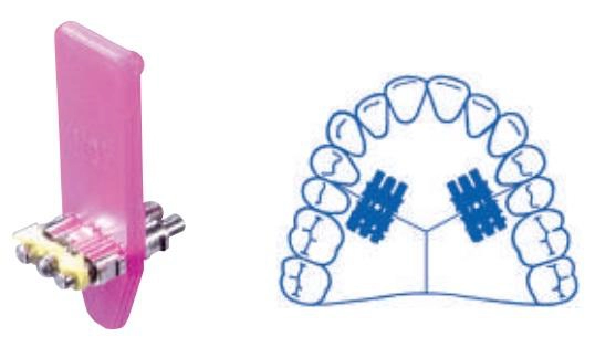 Orthodontic expansion screw medium A0803-96