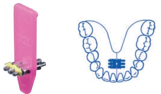 Orthodontic expansion screw universal A0800-96