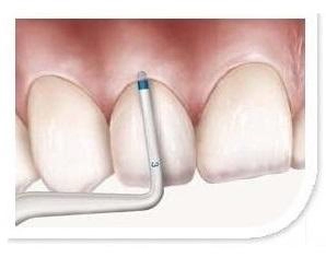 Biotype probe tip, blue