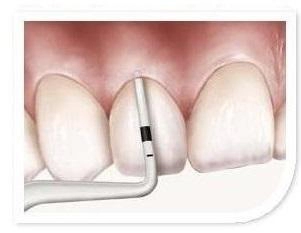 Biotype Probe tip, white